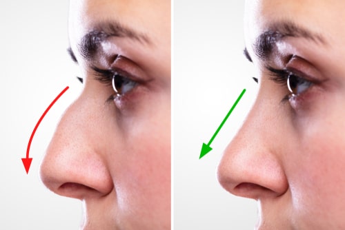rhinoplasty - Before & After